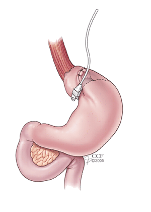 gastric band.