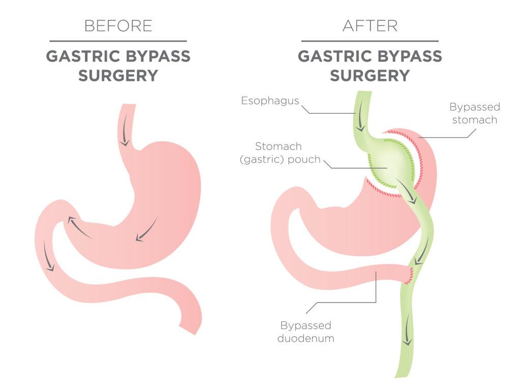 Before & After Gastric Bypass