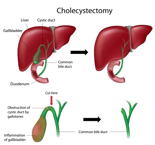 cholecystectomy.